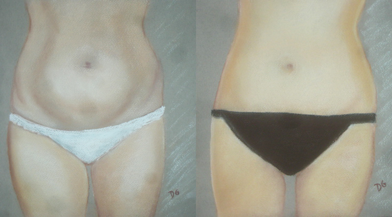 Note technique sur l'abdominoplastie