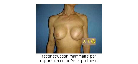 reconstruction mammaire par prothese