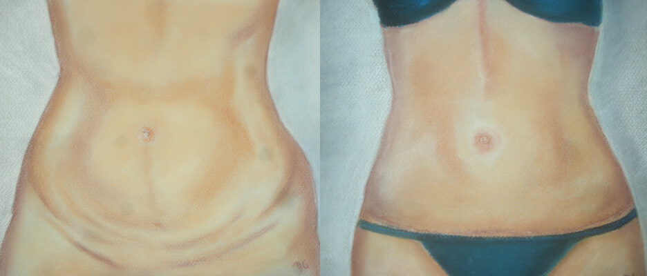 abdominoplastie lifting du ventre