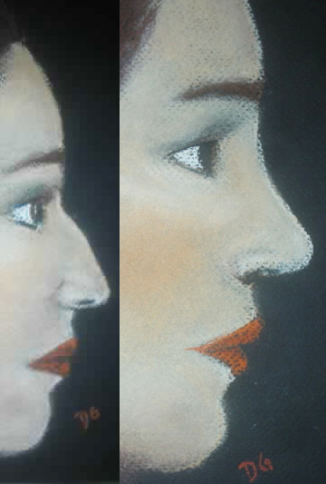 Rhinoplastie