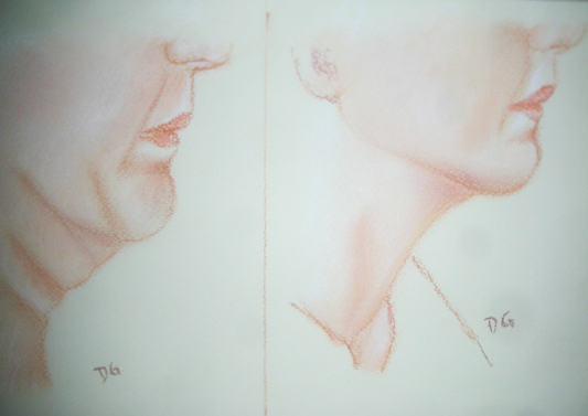 lifting affaissement visage