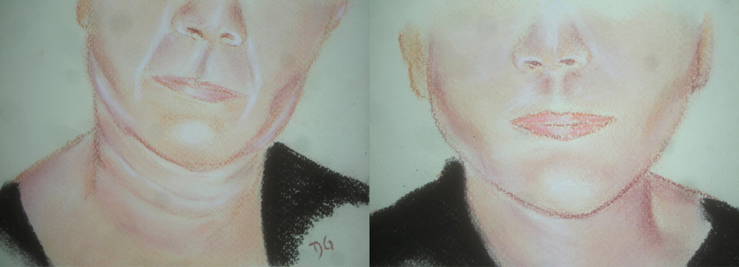 Lifting visage cervico facial