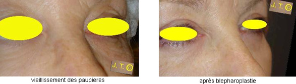 paupiere.jpg