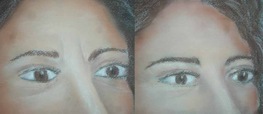 injection botox rides visage